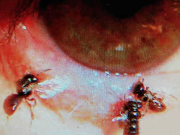 ಈ ಜೇನುನೊಣಗಳು ಕಣ್ಣಿನ ಒಳಗಡೆ ಹೇಗೆ ಹೋದವು