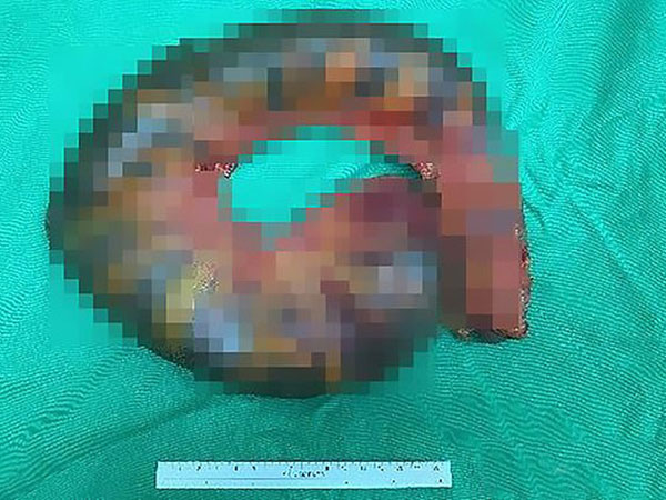 ಆ ವ್ಯಕ್ತಿಯ ಕರುಳಿನಲ್ಲಿ ಮಲವು ತುಂಬಿತ್ತು