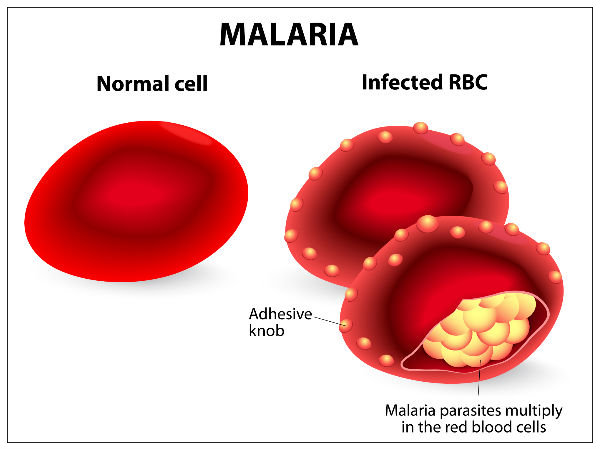 ಮಲೇರಿಯಾಗೆ ಕೆಲವೊಂದು ಆಯುರ್ವೇದ ಚಿಕಿತ್ಸೆಗಳು