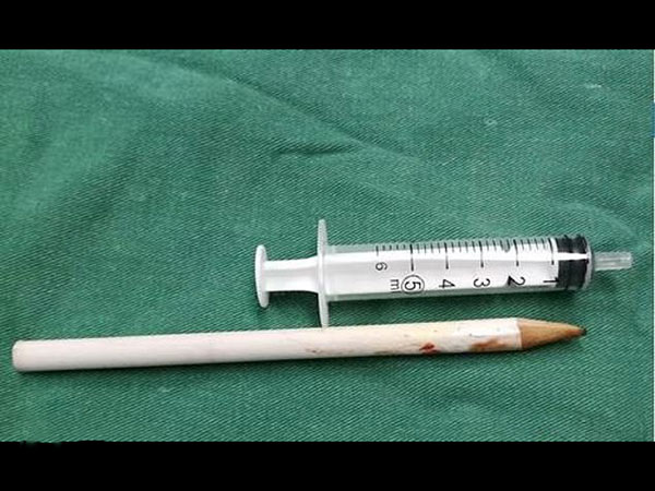 ಪೆನ್ಸಿಲ್ ನ್ನು ಸರ್ಜನ್ ಗಳು ಹೊರತೆಗೆದರು ಪೆನ್ಸಿಲ್ ನ್ನು ಸರ್ಜನ್ ಗಳು ಹೊರತೆಗೆದರು