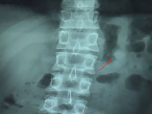 ಆತನಿಗೆ ಯಾವುದೇ ಸಮಸ್ಯೆಯಾಗಲಿಲ್ಲ ಆತನಿಗೆ ಯಾವುದೇ ಸಮಸ್ಯೆಯಾಗಲಿಲ್ಲ