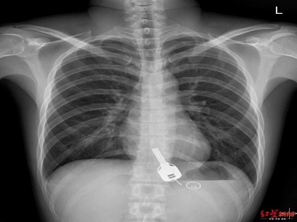 Man Swallowed His House Key!