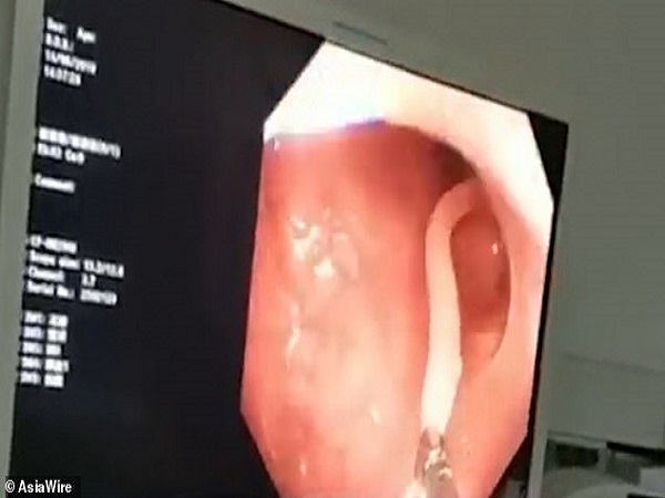 ಹುಳುವನ್ನು ತೆಗೆಯಲಾಯಿತು