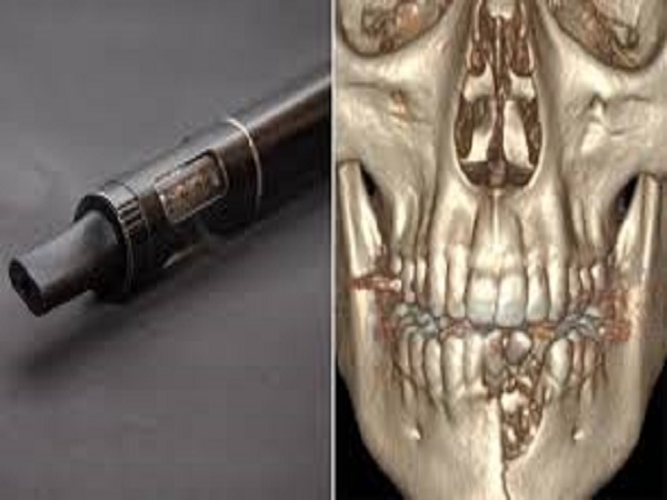 ಆತನಿಗೆ ಇ ಸಿಗರೇಟ್ ನ್ನು ಉಡುಗೊರೆ ನೀಡಲು ಆತನ ತಾಯಿಗೆ ಇಷ್ಟವಿರಲಿಲ್ಲ