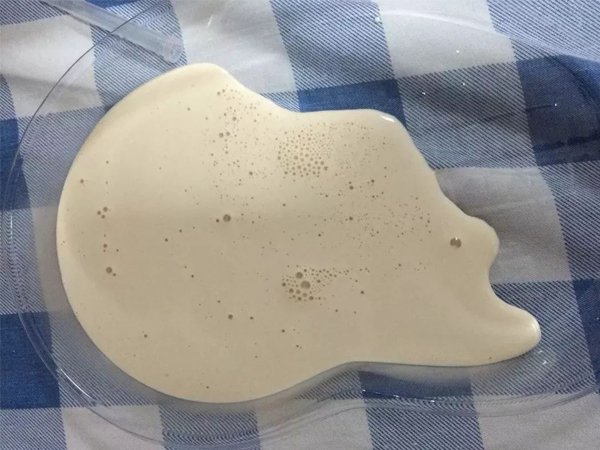 Man Suffers From Gout Due To Beer Addiction