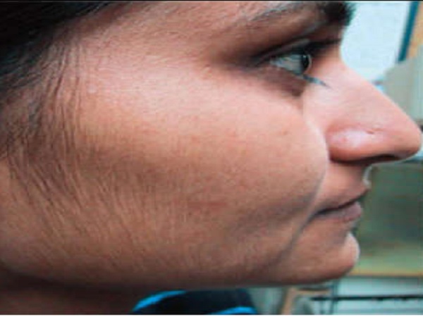 2. ಮುಖದಲ್ಲಿ ಅತಿಯಾಗಿ ಕೂದಲ ಬೆಳವಣಿಗೆ