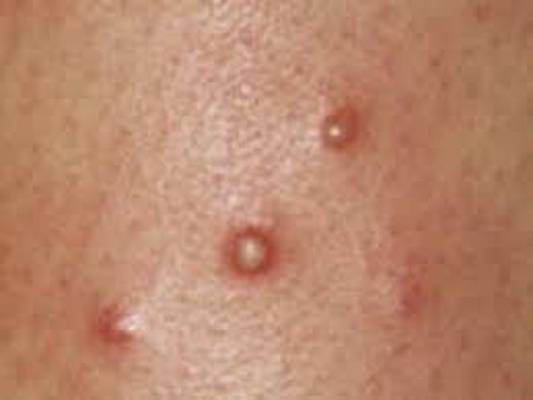 3. ಬಿಸಿ ದದ್ದು