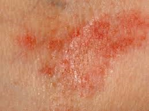 ಶೀತಾಘಾತದ ಲಕ್ಷಣಗಳು