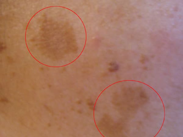 ಮೆಲಾಸ್ಮಾ ಲಕ್ಶಣಗಳನ್ನು ಕಡಿಮೆಗೊಳಿಸಲು ಕೆಲವು ಕ್ರಮಗಳು: