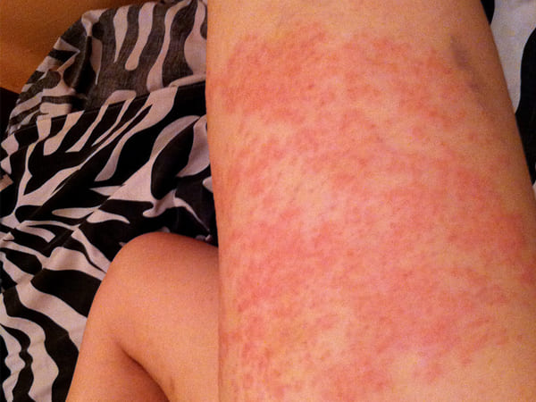 ಬೆವರು ಕಜ್ಜಿಯ ವಿಧಗಳು