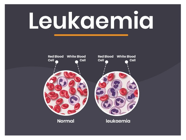 ರಕ್ತ ಕ್ಯಾನ್ಸರ್ ಹೇಗೆ ಉಂಟಾಗುತ್ತದೆ?