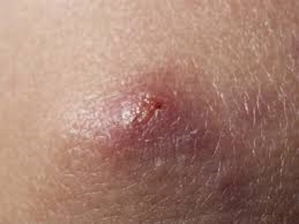 4 ನಿಯೋಸ್ಫೋರಿನ್