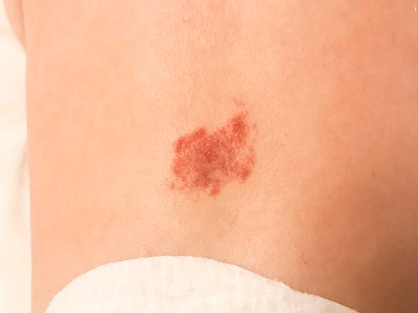 ಈ ಕಲೆಗಳು ಹೇಗೆ ಮತ್ತು ಯಾವಾಗ ನಿವಾರಣೆಯಾಗುತ್ತವೆ?