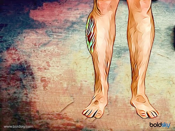 ಕಾಲುಗಳಲ್ಲಿ ಕಾಣಿಸಿಕೊಳ್ಳುವ ಬಾವು