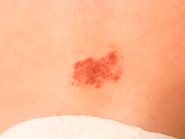 ಸ್ಟ್ರಾಬೆರಿ ಹಿಮಾಂಜಿಯೋಮಾ ಕಲೆಗಳು ಎಲ್ಲೆಲ್ಲಿ ಕಾಣಿಸಿಕೊಳ್ಳುತ್ತವೆ?