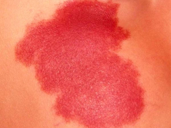 ಈ ತೊಂದರೆಯನ್ನು ನೀವು ಗಮನಿಸಿದ ಬಳಿಕ ವೈದ್ಯರಲ್ಲಿ ಯಾವಾಗ ಸಲಹೆ ಪಡೆಯಬೇಕು?