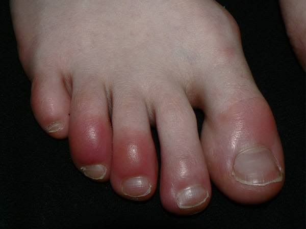 COVID ಕಾಲ್ಬೆರಳುಗಳು ಎಂದರೇನು?: