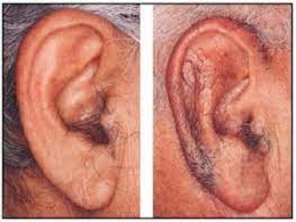 ಕಿವಿಯ ಮೇಲೆ ಕೂದಲು ಬೆಳೆಯೋದು ಯಾಕೆ?