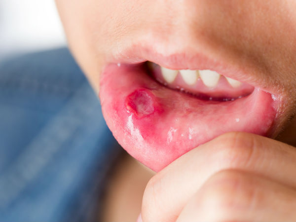 ಬಾಯಿಯ ಹುಣ್ಣುಗಳಿಗೆ ಚಿಕಿತ್ಸೆ: