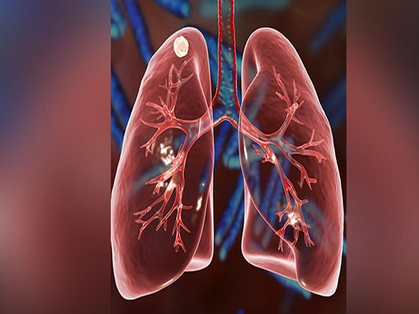 ಟಿಬಿ ಮತ್ತು ಕೋವಿಡ್‌ 19 ನಡುವೆ ಸಂಬಂಧವಿದೆಯೇ?