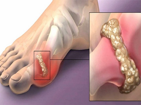 1. ಪ್ಯೂರಿನ್ ನಿಖರವಾಗಿ ಏನು? 1. ಪ್ಯೂರಿನ್ ನಿಖರವಾಗಿ ಏನು?