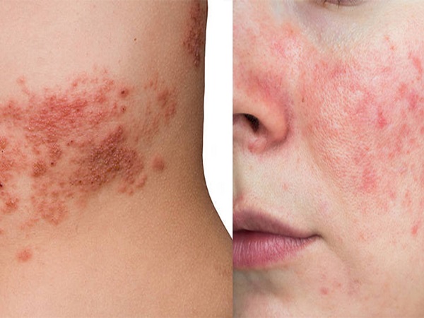 2. ತುರಿಕೆ ಮತ್ತು ಕೆಂಪು ದದ್ದುಗಳು ಕಾರಣವಾಗಬಹುದು