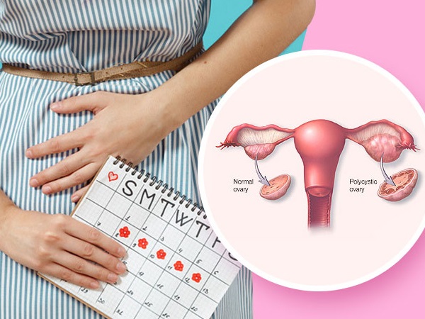 ಹದಿಹರೆಯದವರಲ್ಲಿ ಪಿಸಿಒಎಸ್ ಸಾಮಾನ್ಯವೇ?: