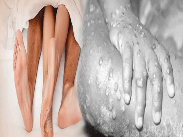 ಲೈಂಗಿಕತೆಯಿಂದ ಹರಡುತ್ತದೆ ಮಂಕಿಪಾಕ್ಸ್!