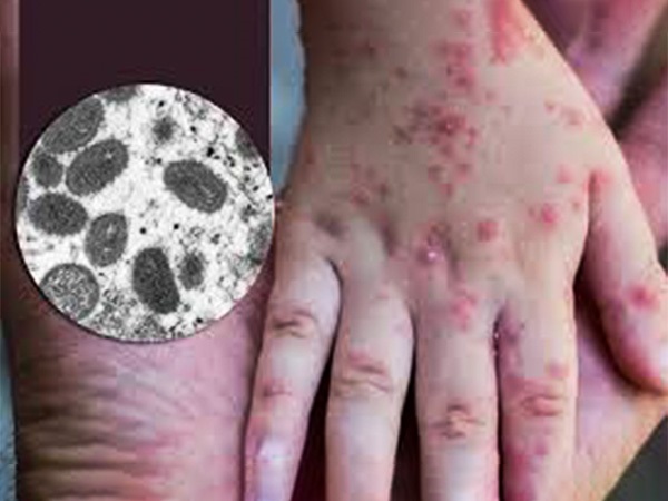 ಮಂಕಿಪಾಕ್ಸ್ ಬಗ್ಗೆ ಪೋಷಕರು ಏನು ತಿಳಿದುಕೊಳ್ಳಬೇಕು?