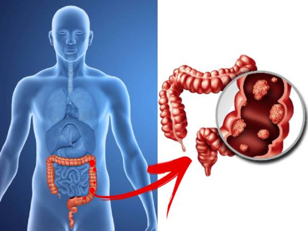 Colon Cancer, Colon Cancer,