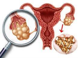 PCOS : These Physical Changes Occur when you have pcos, how to treat pcos read on?,