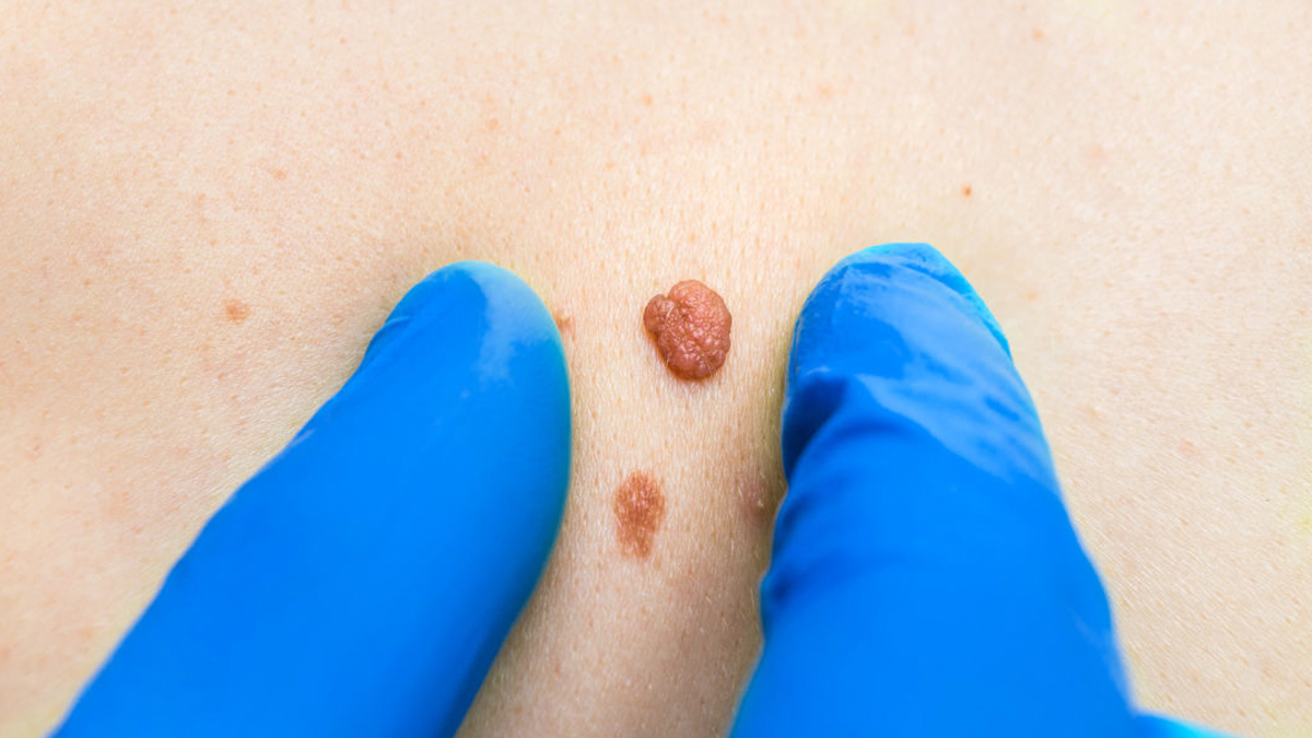 Skin Cance Skin Cance