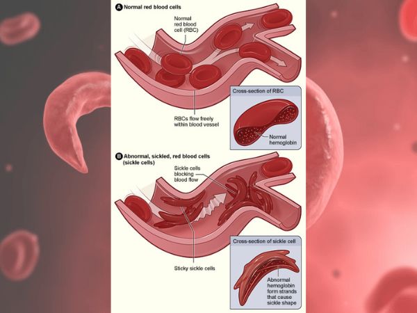ಮಗುವಿಗೆ ಸಿಕಲ್‌ ಸೆಲ್ ಅನಿಮಿಯಾ ಇದ್ದರೆ ಬದುಕಿವುದೇ?'