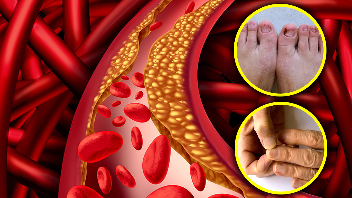 High Cholesterol Symptoms In Kannada : Indications On Your Toes and Fingers High Cholesterol Symptoms In Kannada : Indications On Your Toes and Fingers