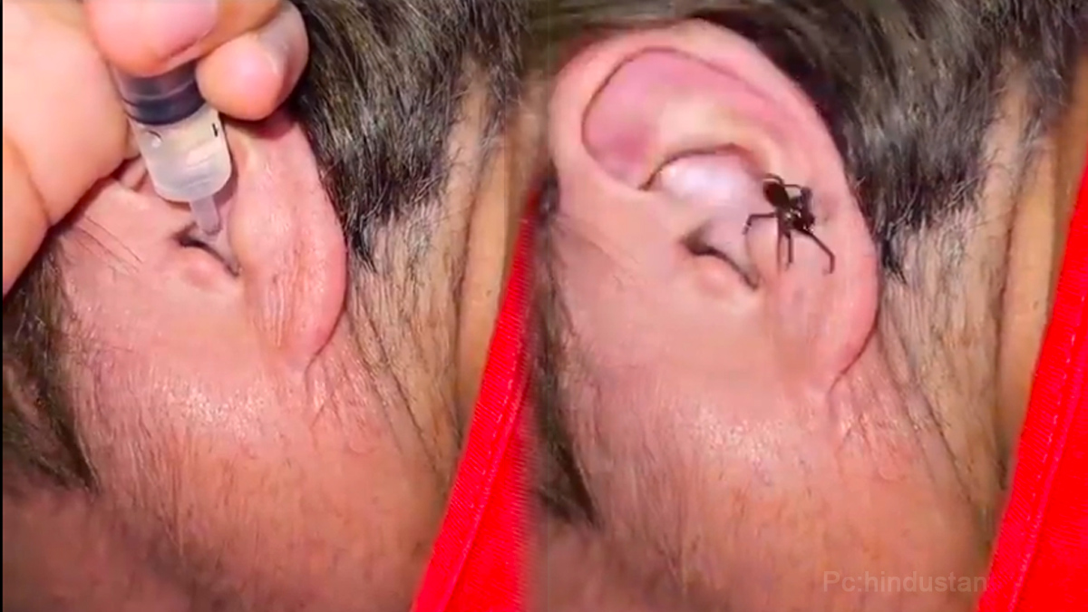 Live Spider Crawls Out Of a Mans Ear. Video Goes Viral. Know More Details in Kannada Live Spider Crawls Out Of a Mans Ear. Video Goes Viral. Know More Details in Kannada