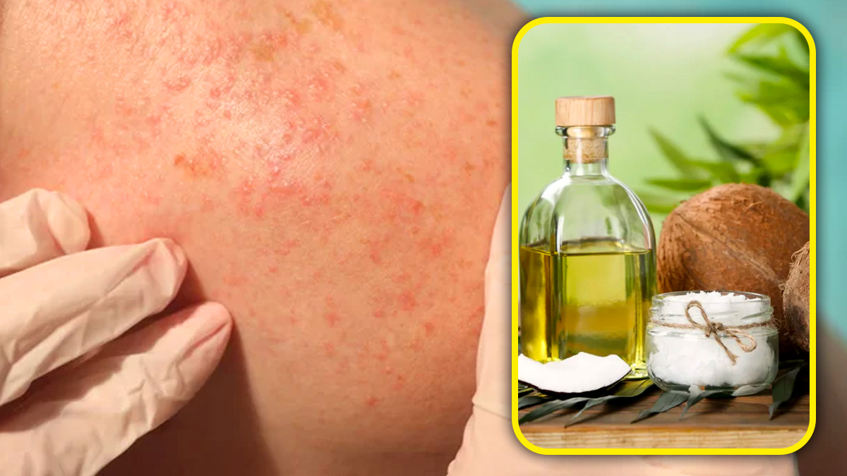 How To Use Coconut Oil To Avoid Heat Rashes and Sun Burn How To Use Coconut Oil To Avoid Heat Rashes and Sun Burn