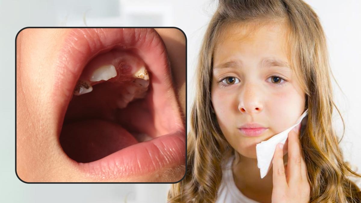 Dental Abscesses:What are the reason for Build Up of Pus in the Teeth or Gums In Kannada Dental Abscesses:What are the reason for Build Up of Pus in the Teeth or Gums In Kannada