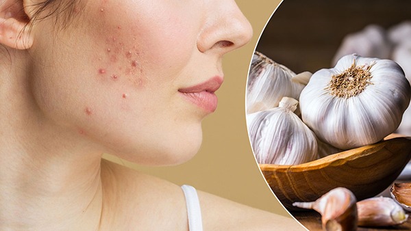 garlic to reduce pimple,