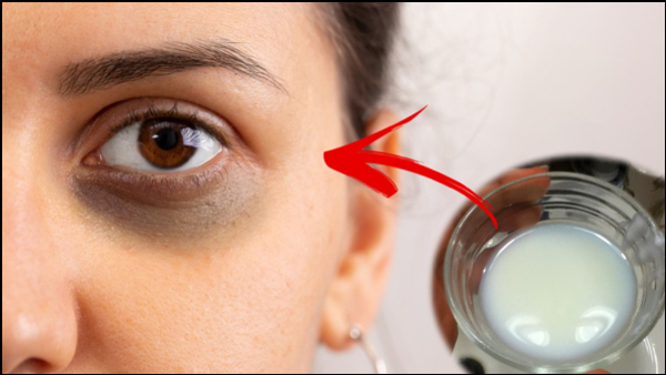 Dark-Circles-Under-Your-Eyes in Kannada Dark-Circles-Under-Your-Eyes in Kannada
