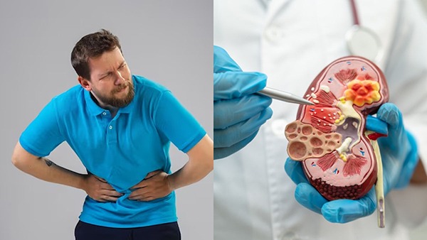 Signs Of Kidney Damage