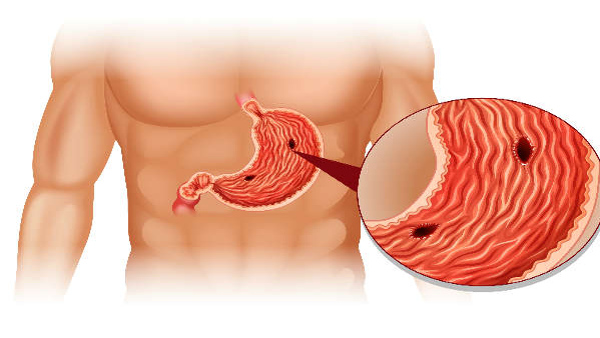 Symptoms of Stomach cancer in Kannada
