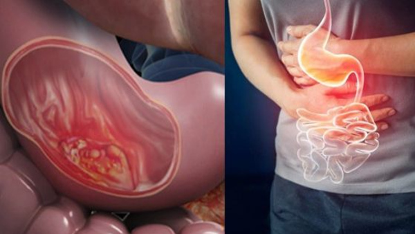 Symptoms of Stomach cancer in Kannada