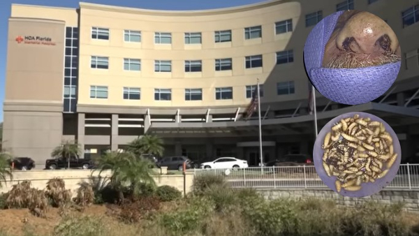 Doctors Remove Live Bugs From Mans Body
