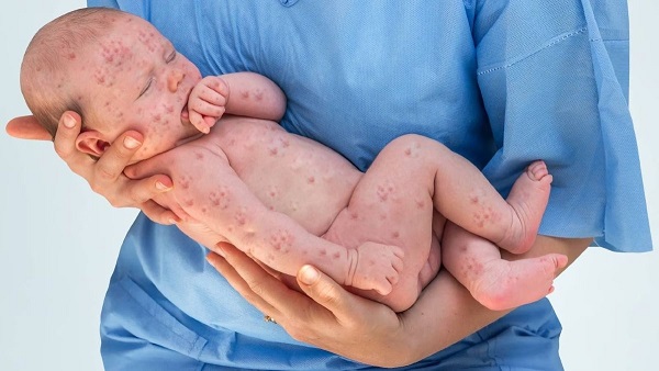Increasing Measles Increasing Measles