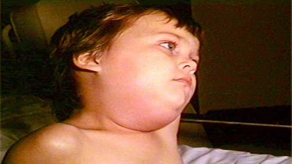 Mumps In Kids