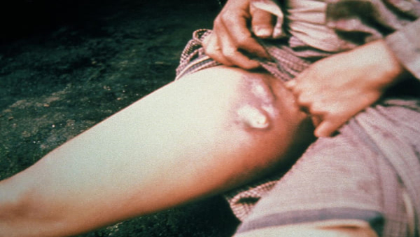 symptoms of bubonic plague In Kannada