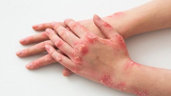 What Is Alaskapox and Symptoms