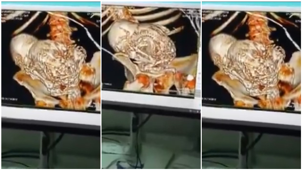 Woman Carries Stone Child In Abdomen For 56 Years Dies After Operation