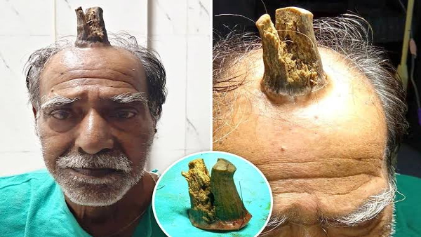 Animal Horn Growing On Mans Head In MP Photos Gone Viral Animal Horn Growing On Mans Head In MP Photos Gone Viral
