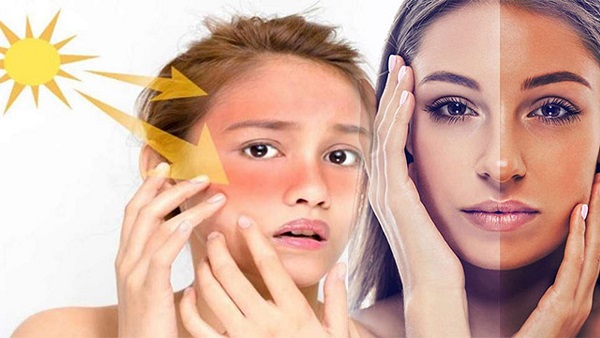 Simple Hacks To Remove Suntan Simple Hacks To Remove Suntan